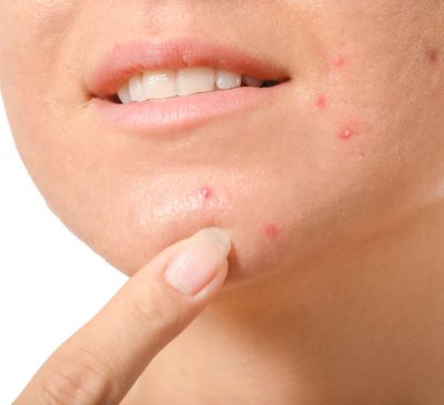 young-woman-with-acne-problem-white-closeup